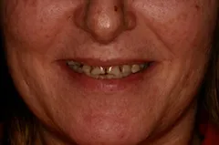  full mouth reconstruction case study