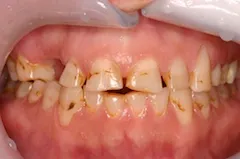full mouth reconstruction case study
