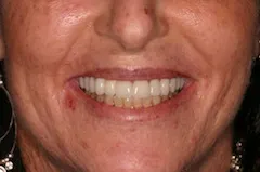  full mouth reconstruction case study